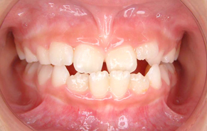 小児矯正のみで終了1