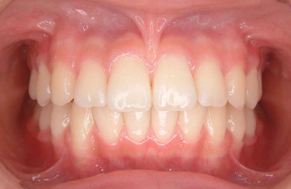 小児矯正のみで終了4