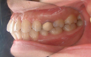 前歯のガタガタと口元の突出感 before2