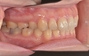 前歯のガタガタと口元の突出感 after3